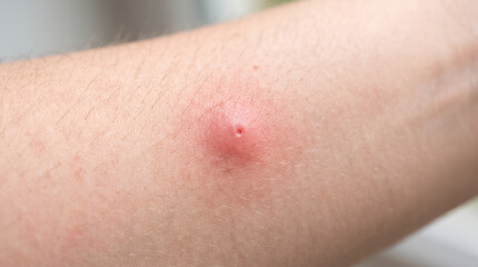 Fototapeta premium Inflamed insect bite on human skin showing redness and swelling from an allergic reaction or infection