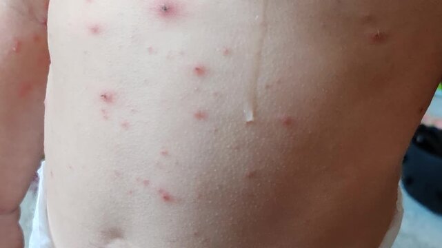 young kids with chickenpox