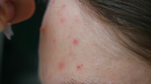 Close up woman fingers applying translucent hydrocolloid patch to pimple on forehead, part of skincare routine, treating acne, problem skin inflammation. Woman applying pimple patch on forehead acne