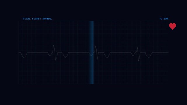 Electrocardiogram monitor showing a normal heartbeat rhythm on screen