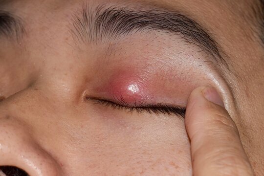 Closeup of a red chalazion nodule on an upper eyelid