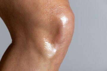 Fototapeta premium Close up of human knee joint with glossy skin and pain relief cream concept