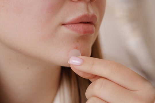 Applying Acne Patch for Effective Skin Care Treatment