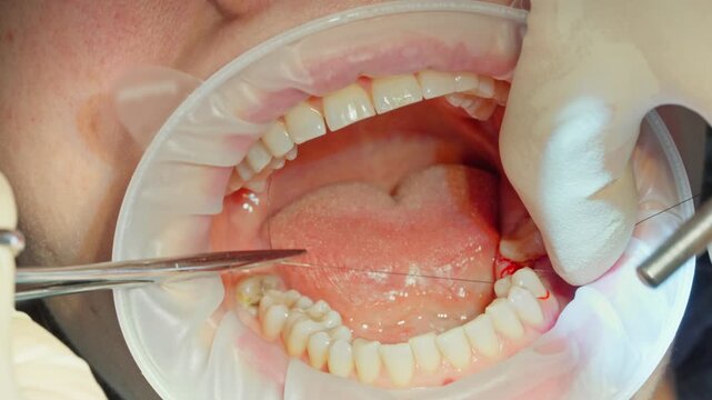 Close up a qualified dental surgeon stitches the gum with sterile threads after installing a dental implant bode, which is screwed into the bone jaw
