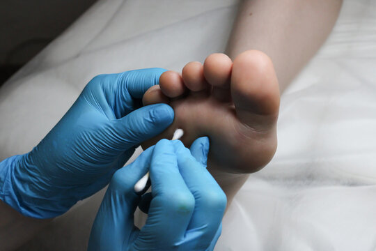 Podiatrist removing or cauterizing verruca on kid sole