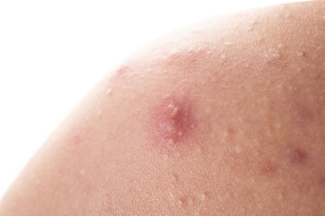 Fototapeta premium Dermatology concept with acne skin pores. Skin inflammation with whiteheads and acne detail. Macro shot of skin irritation with acne. Detailed skin with acne.