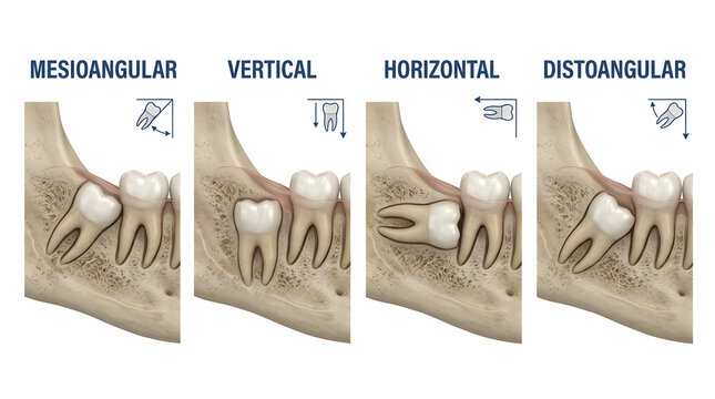 Diagram of wisdom tooth impaction orientations