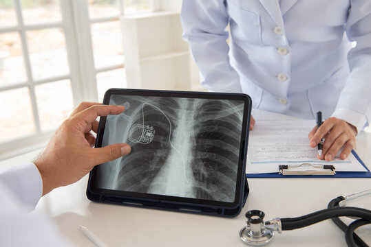 cardiothoracic surgeon team looks medical x-ray image of pacemaker implantation cardioverter defibrillator in chest patient at hospital.