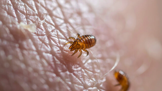 Close-up macro of a flea on human skin with parasite infestation dermatology