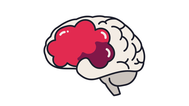 Illustration of Human Brain With Tumor Growth