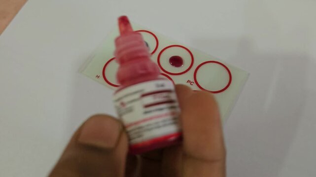 ABO and Rh blood grouping slide agglutination test performed in clinical laboratory. Blood samples mixed with antisera on a blood typing card for determining ABO and Rh (D) blood groups