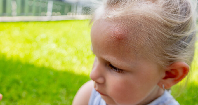 Little girl with a big swollen mosquito bite on her forehead outdoors