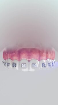 Braces Installation. 3D animation of indirect orthodontic bracket bonding with a transfer tray for precise braces placement.
