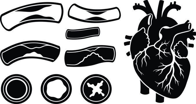Atherosclerosis disease vector set with human heart coronary anatomy artery plaque buildup stages and blocked vessel cross sections for medical infographics