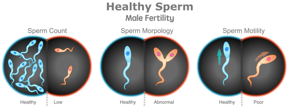 Sperm healthy, male fertility problems. Count, morphology, motility. Compare, normal, low, abnormal, poor. Microscopic cells compare. Semen movement shape. Test tube baby, IVF. Vector illustrator