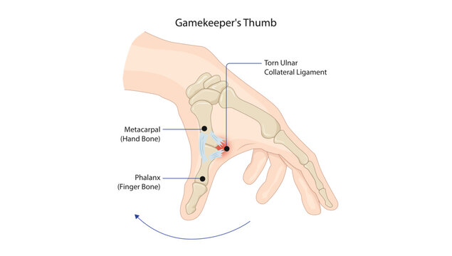 Gamekeeper's Thumb, depicting Gamekeeper's thumb, showing injury to the ulnar collateral ligament (UCL) of the thumb metacarpophalangeal joint.