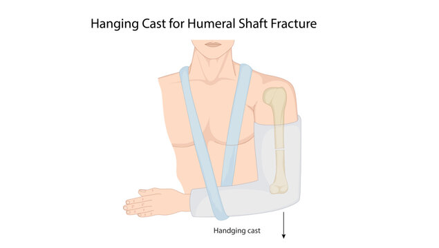 Hanging Cast for Humeral Shaft Fracture, the hanging cast technique used for conservative management and alignment of humeral shaft fractures.