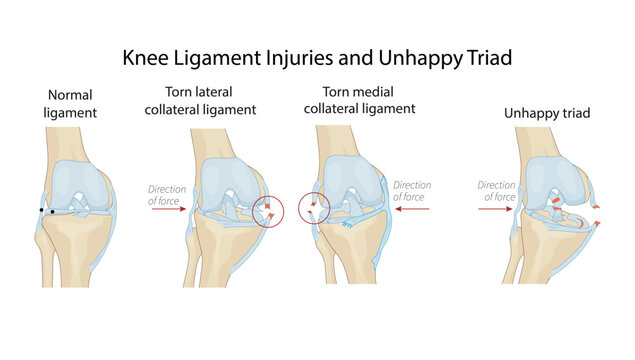 Knee Ligament Injuries and Unhappy Triad, depicting the unhappy triad of the knee, highlighting injuries to the anterior cruciate ligament (ACL), medial collateral ligament (MCL), and medial meniscus.