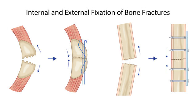 Internal and External Fixation of Bone Fractures, internal and external fixation techniques used to stabilize bone fractures during orthopedic trauma surgery.