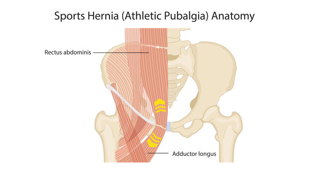 Sports Hernia (Athletic Pubalgia) Anatomy, the anatomy of sports hernia (athletic pubalgia), highlighting injury to the lower abdominal wall, inguinal region, and adductor muscle attachments.