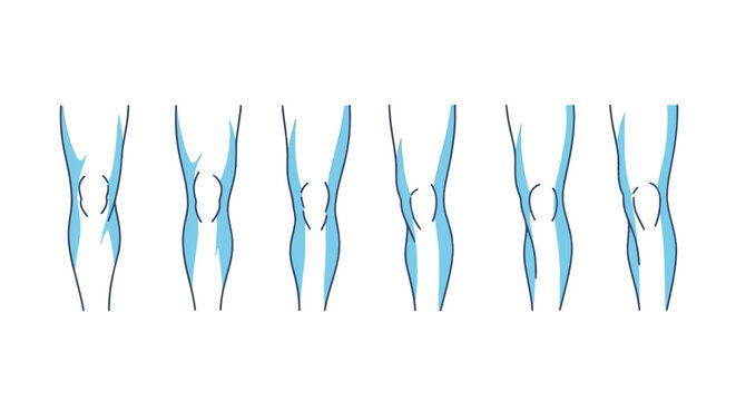 Male leg shape classification diagram showing various knee alignments including genu varum, genu valgum, and neutral posture for medical and anatomical study purposes.
