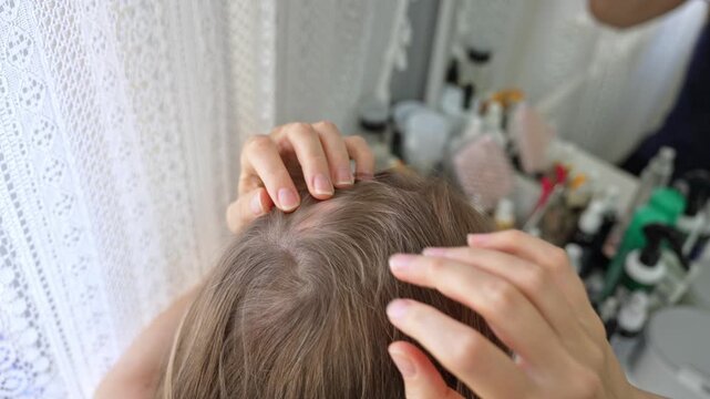Top-down view of a young woman's head showing a bald patch. She is parting her thinning hair with her hands to examine the results of alopecia, hair loss, or telogen effluvium