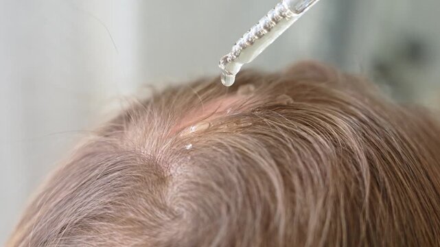 Close-up view of a woman applying a cosmetic hair growth serum with a dropper to a bald patch on her scalp, a common treatment for alopecia, hair loss, and thinning problems