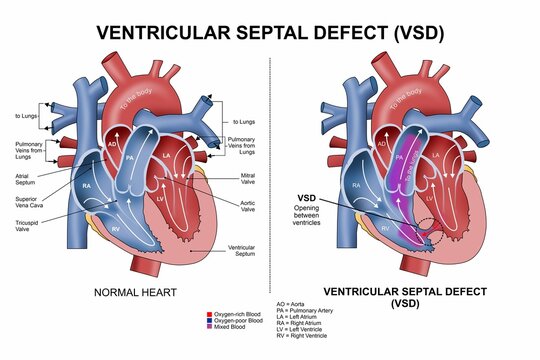 Ventricular Septal Defect (VSD) Heart Illustration
