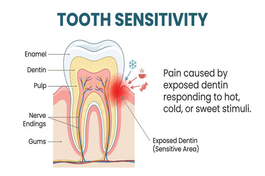 Tooth cross-section showing exposed dentin reacting to hot, cold, or sweet stimuli.