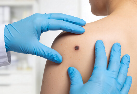Doctor checking dark mole on patient shoulder close up, dermatologist examining skin spot for cancer, oncology examination, medical screening, mole, skin check, health care.