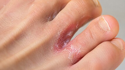 Fototapeta premium Foot with athlete foot infection between toe. Scaling and peeling skin caused by fungal condition. Medical dermatology concept for podiatry treatment, fungal disease and skin health.