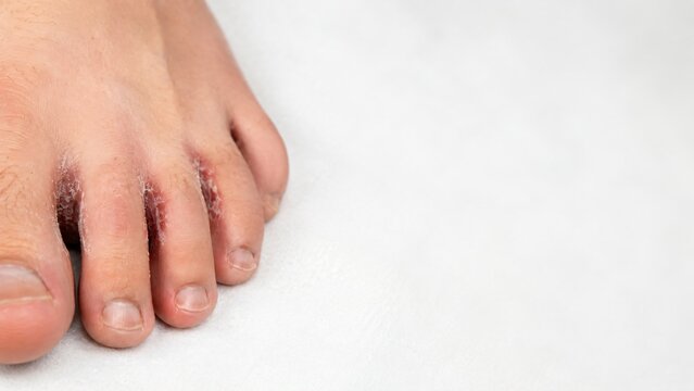 Human foot showing signs of fungal skin infection between toes. Athlete foot condition with flaky red rash. Medical dermatology concept for skin disease treatment and hygiene care.