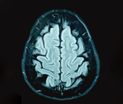 Magnetic resonance image (MRI) of the brain. MRI scan of human brain axial view with black background.
