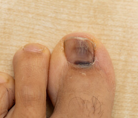 Naklejka premium A man's foot has a black spot on it