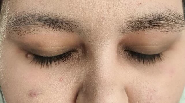 Woman with eye discomfort and watery eyes, vision problems and eye health concept, ophthalmology and healthcare.