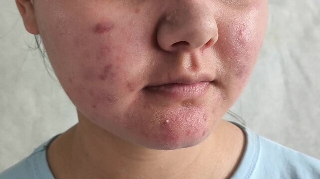 Young woman with acne and facial redness, problematic skin concept, dermatology, skincare and facial health awareness.