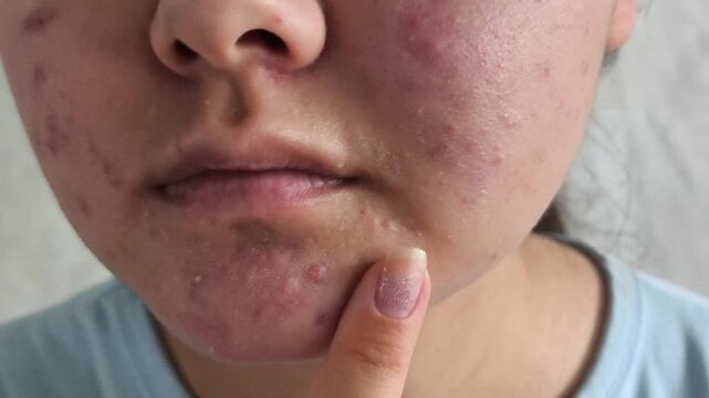 Teenage girl with facial acne and skin irritation, skincare routine, beauty and self care concept, problematic skin treatment.