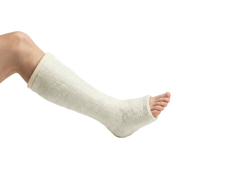 Medical leg cast on injured patient, white fiberglass orthopedic plaster for broken bone recovery, orthopedic leg bandage for fracture healing isolated on Transparent Background