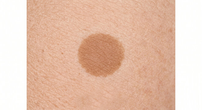 Solar Lentigo (Sun Spot) - hyperpigmented brown macule on sun-exposed human skin - Macule in Human Skin &mdash; Medical Dermatology Plate (4-100) 