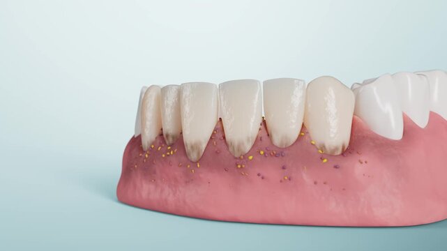 Gum recession, tooth loss, oral health
