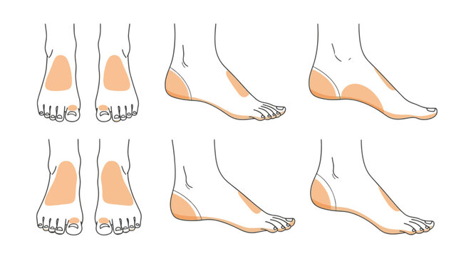 Medical Vector Illustration of Female Foot Anatomy Showing Shape Variations and Pressure Points from Front and Side Profiles, Anatomical Diagrams for Podiatry and Orthopedic Health Care