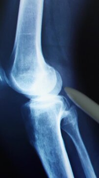 Doctor radiologically analyzing the knee with blue x-ray
Hand of a doctor analyzing and pointing with a pen to the affected area.
