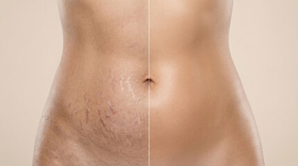 Naklejka premium Female Abdomen Showing Before and After Stretch Mark Reduction