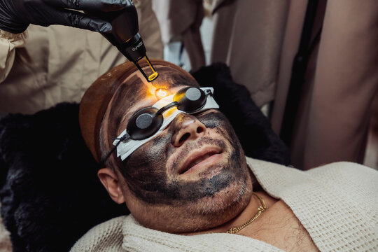 Middle-aged man undergoes a Carbon Laser Facial, also known as the Hollywood Laser Peel, while wearing protective eye shields during a professional skin rejuvenation treatment.
