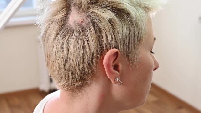 A hand in a medical glove holds a large clump of lost hair against the backdrop of a patient with baldness. A large mole on the patient's scalp. Skin growth removal. Baldness treatment.