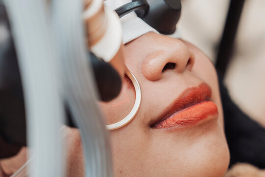 Young Southeast Asian woman undergoes a CO2 fractional laser facial treatment while wearing protective eye shields during a professional skin resurfacing procedure at a medical aesthetic clinic.