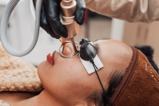 Young Southeast Asian woman undergoes a CO2 fractional laser treatment on the nose area while wearing protective eye shields during a professional skin resurfacing session.