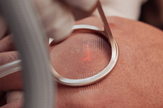 Closeup of fractional CO2 laser treatment at an aesthetic clinic for keloid reduction and scar remodeling