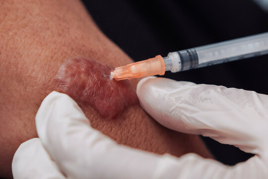 Close-up of a patient receiving an intralesional corticosteroid injection into a keloid scar before CO2 fractional laser treatment in a dermatology and aesthetic clinic.