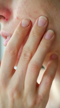 Woman touching her face with allergic rash, showing symptoms of dermatitis, urticaria, food intolerance on sensitive skin while suffering from reaction. Woman with skin allergy touching irritated face